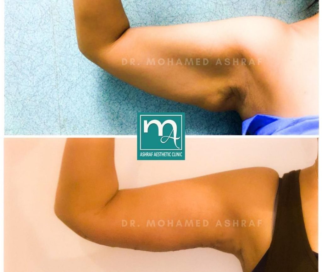arm lift surgery